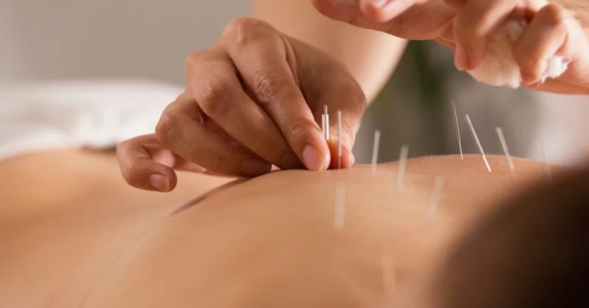 Acupuncture Singapore